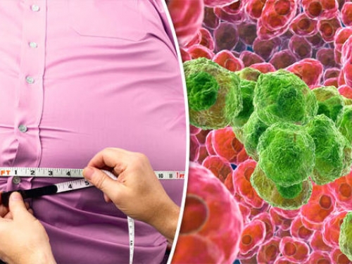 Má alimentação e obesidade elevam incidência de câncer colorretal